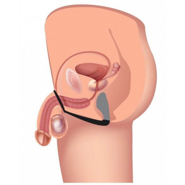 Imagem infográfica de anel peniano acoplado com plug anal na próstata