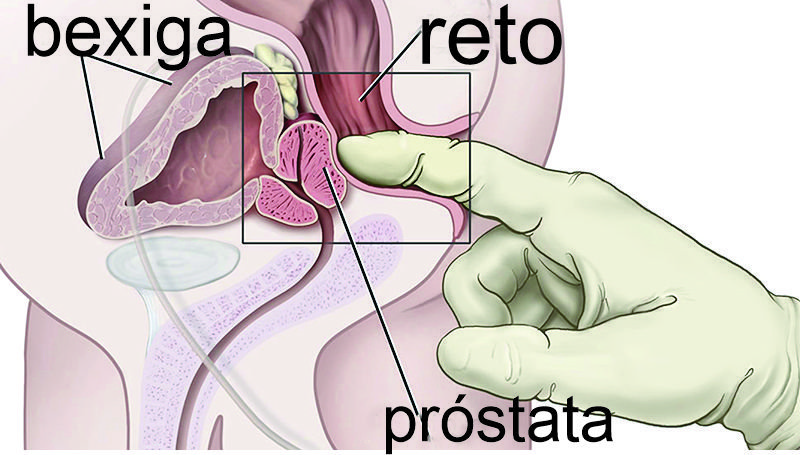 ilustração bexiga, reto e próstata sendo tocada por dedo de mão com luva